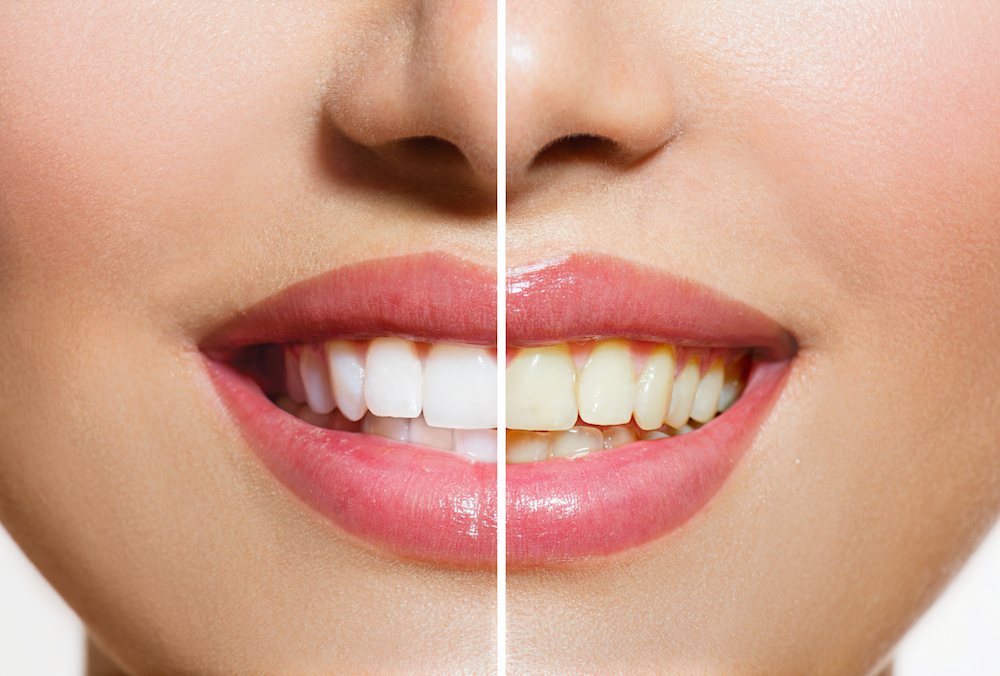 Stained Teeth | 68745 Dentist